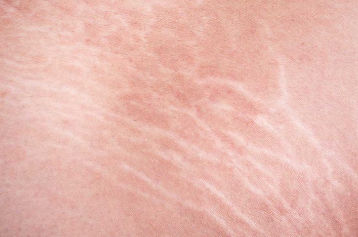 Is there a treatment to remove stretch marks?